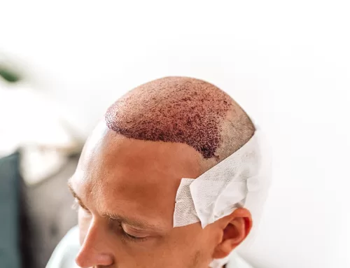 Mastering FUE Hair Transplantation: Punch precision and Techniques