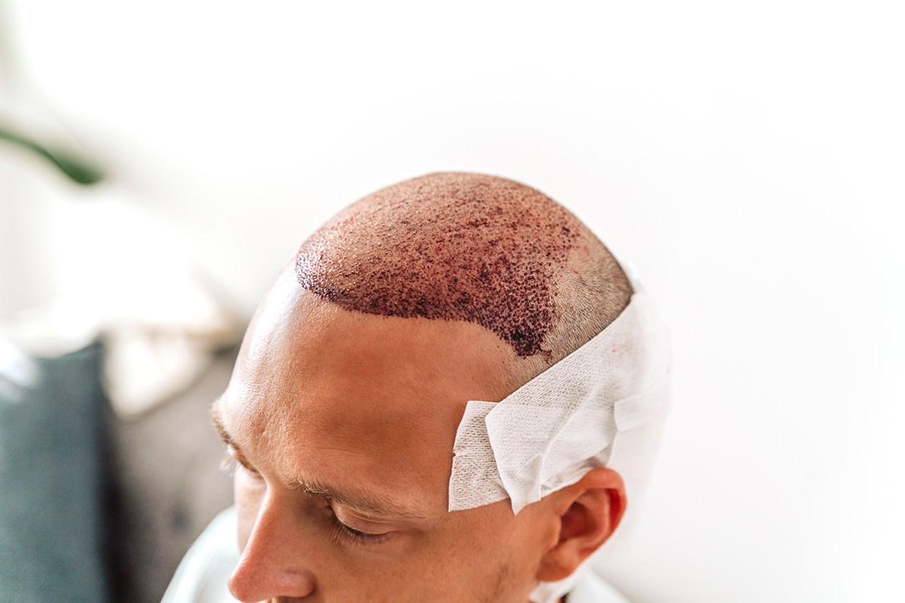 Man after a hair transplant surgery with FUE Punch technique