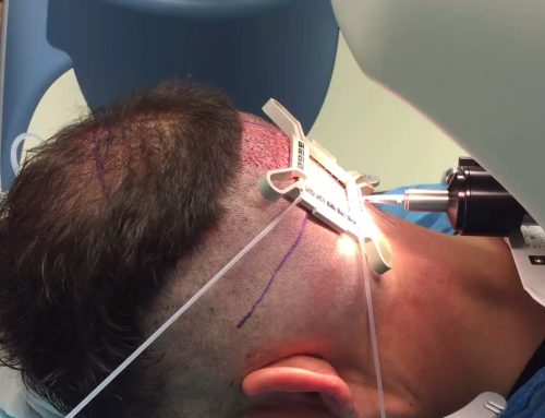 Unlocking the Future: Latest Advancements in Hair Transplant Surgery