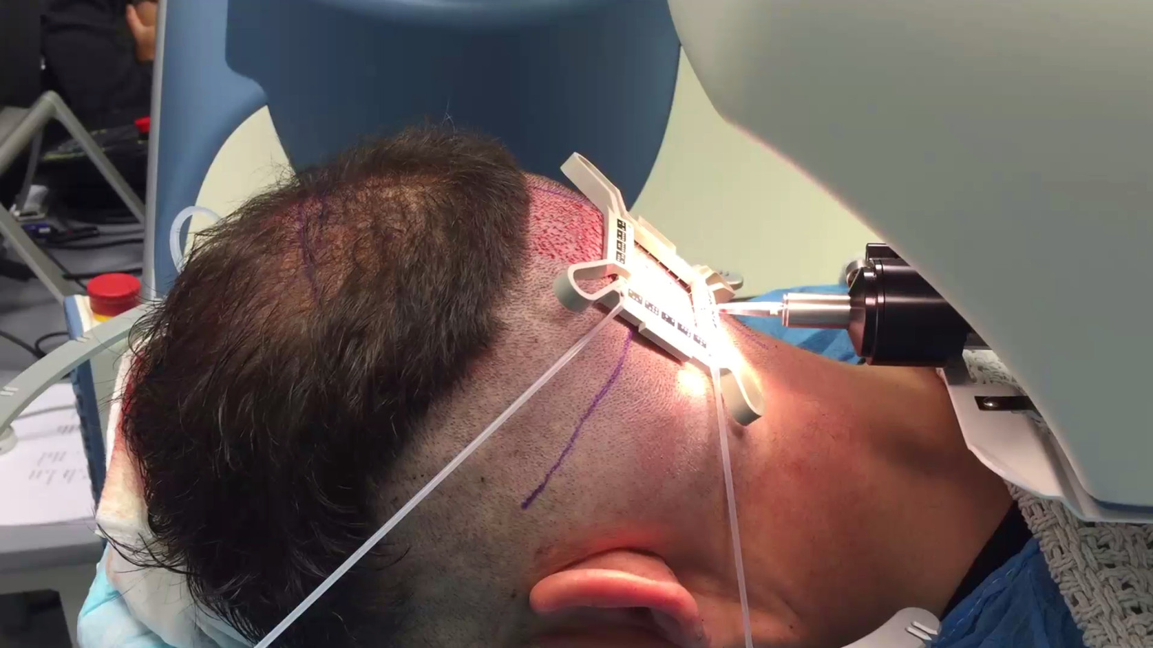 the ARTAS robot performing hair transplant surgery
